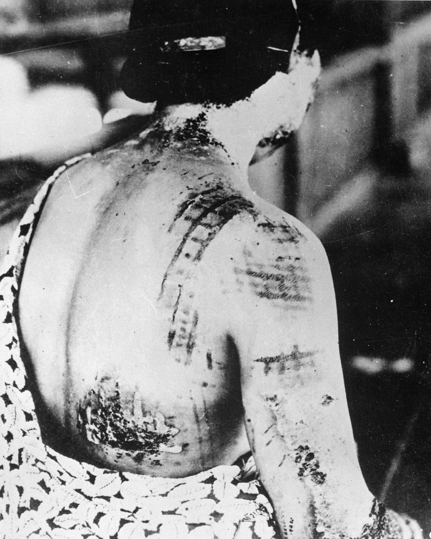 Burns On Body From Atomic Bomb Glossy Poster Picture Photo Print Banner  Booma Prints